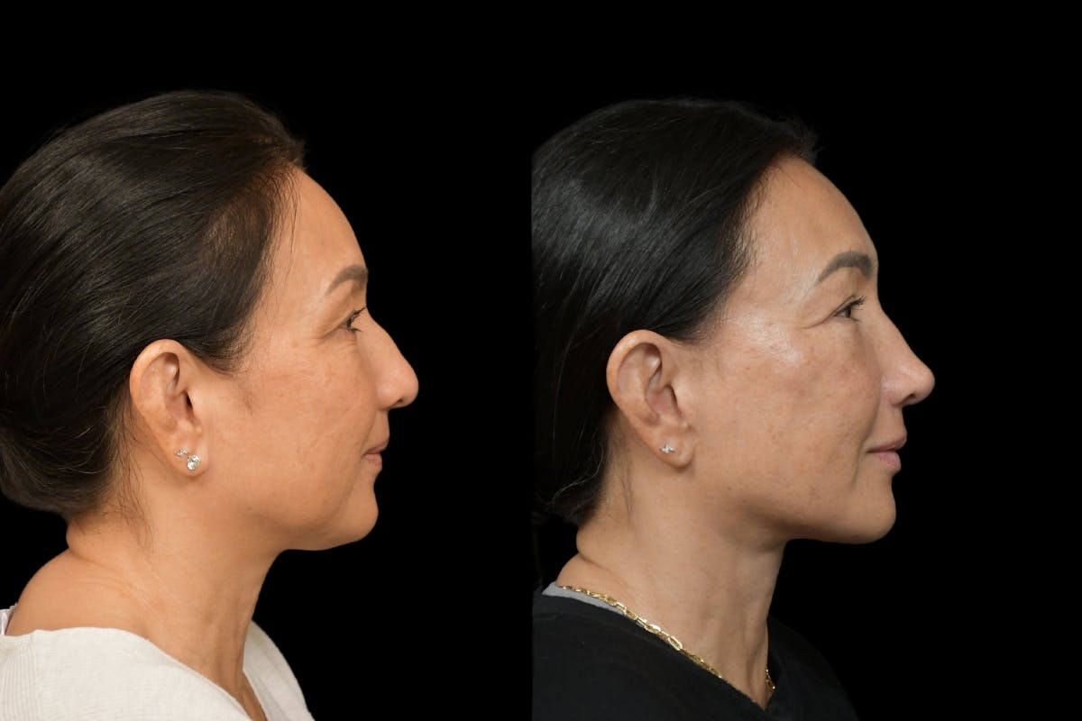 Rhinoplasty Before & After Gallery - Patient 264501 - Image 4