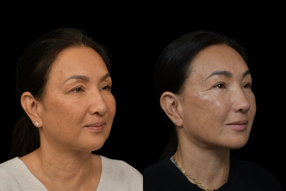 Rhinoplasty Before & After Gallery - Patient 264501 - Image 3