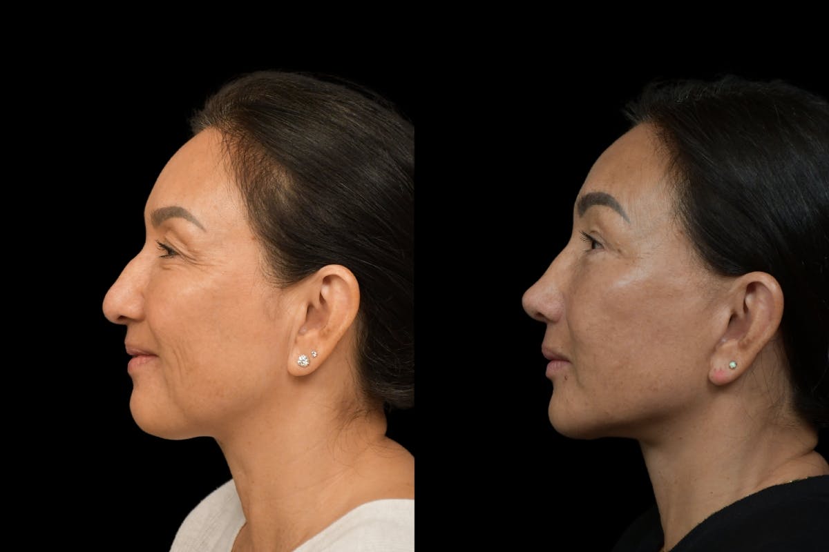 Rhinoplasty Before & After Gallery - Patient 264501 - Image 2