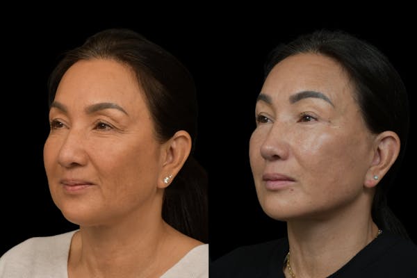 Rhinoplasty Before & After Gallery - Patient 264501 - Image 1