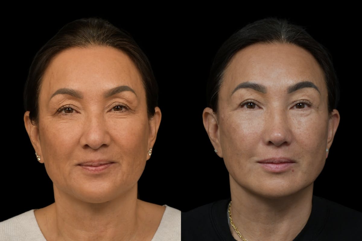 Rhinoplasty Before & After Gallery - Patient 264501 - Image 5