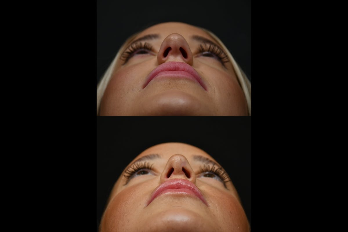 Rhinoplasty Before & After Gallery - Patient 317118 - Image 5