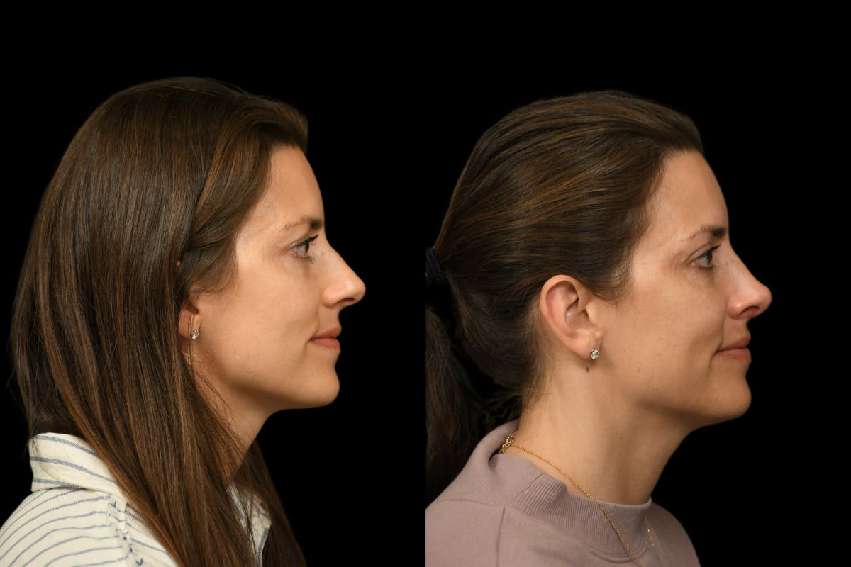 Rhinoplasty Before & After Gallery - Patient 541855 - Image 4