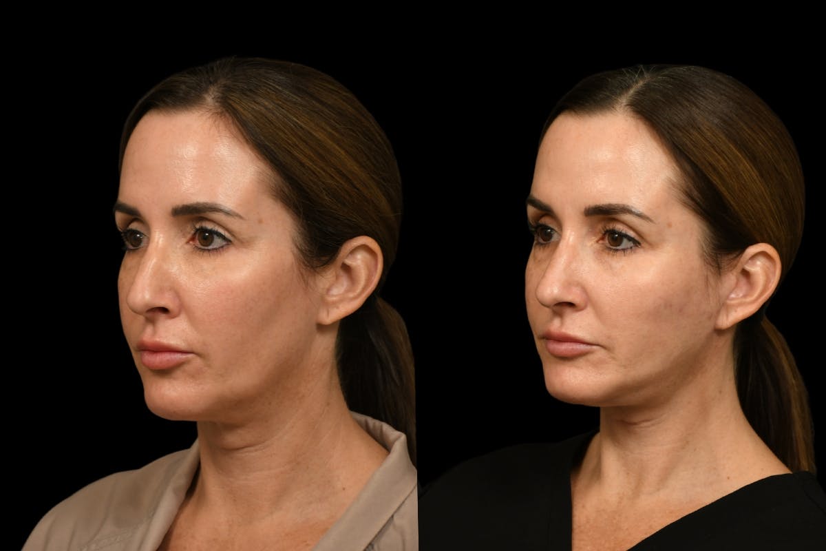 Changes Rapid Lift  Before & After Gallery - Patient 377971 - Image 1