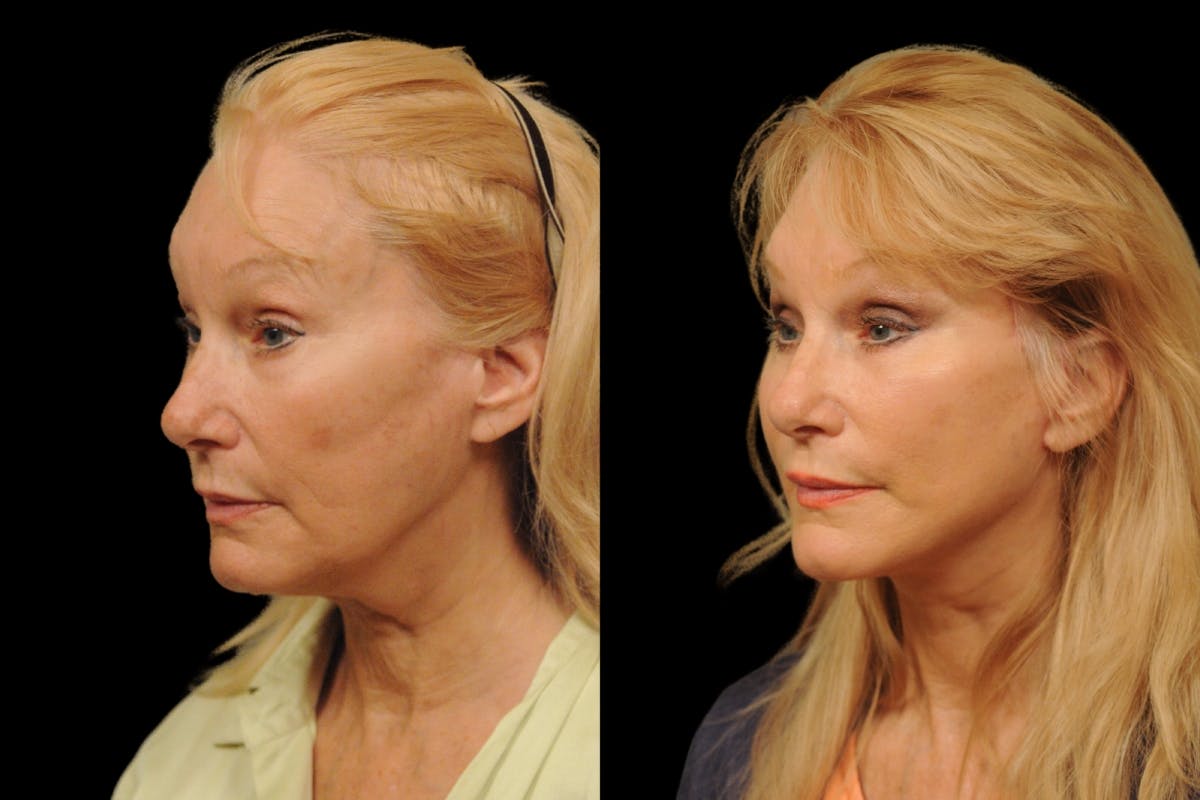 Changes Rapid Lift  Before & After Gallery - Patient 246949 - Image 1