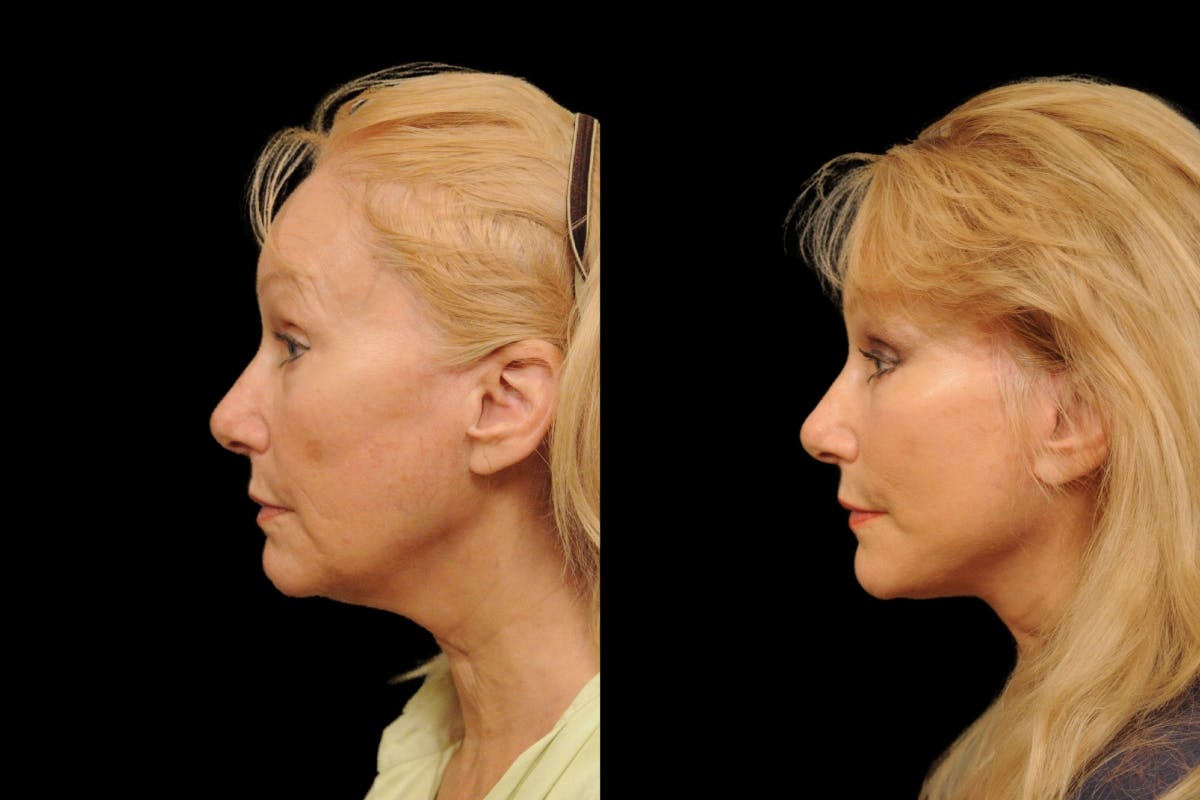 Changes Rapid Lift  Before & After Gallery - Patient 246949 - Image 2