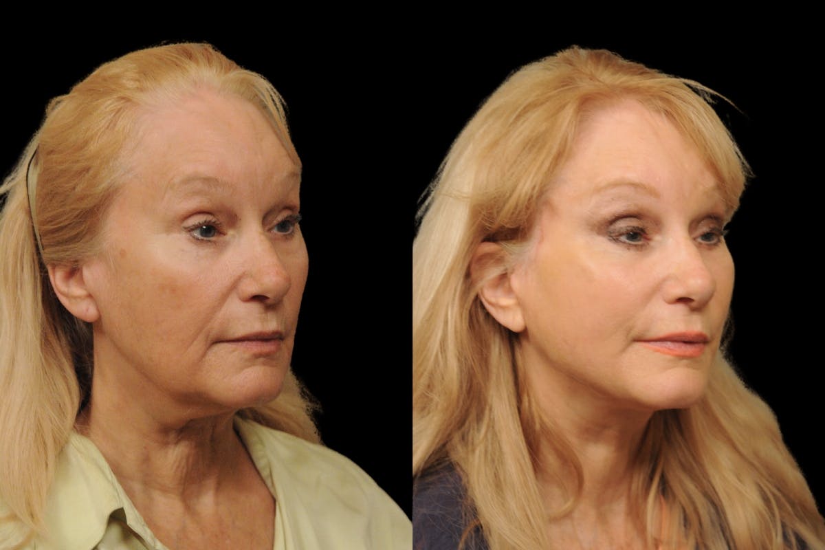 Changes Rapid Lift  Before & After Gallery - Patient 246949 - Image 3