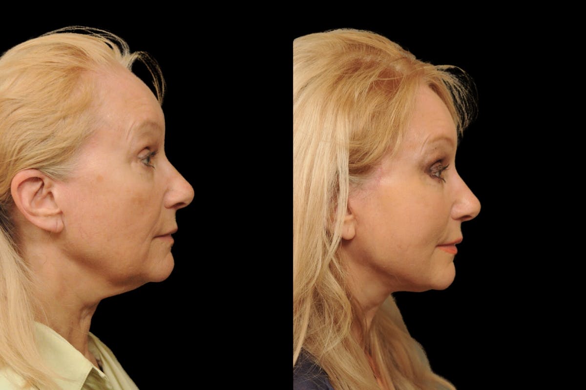 Changes Rapid Lift  Before & After Gallery - Patient 246949 - Image 4