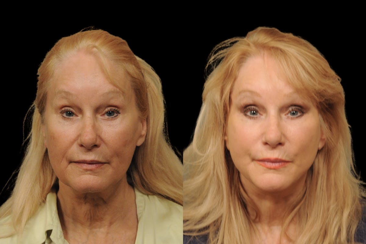 Changes Rapid Lift  Before & After Gallery - Patient 246949 - Image 5