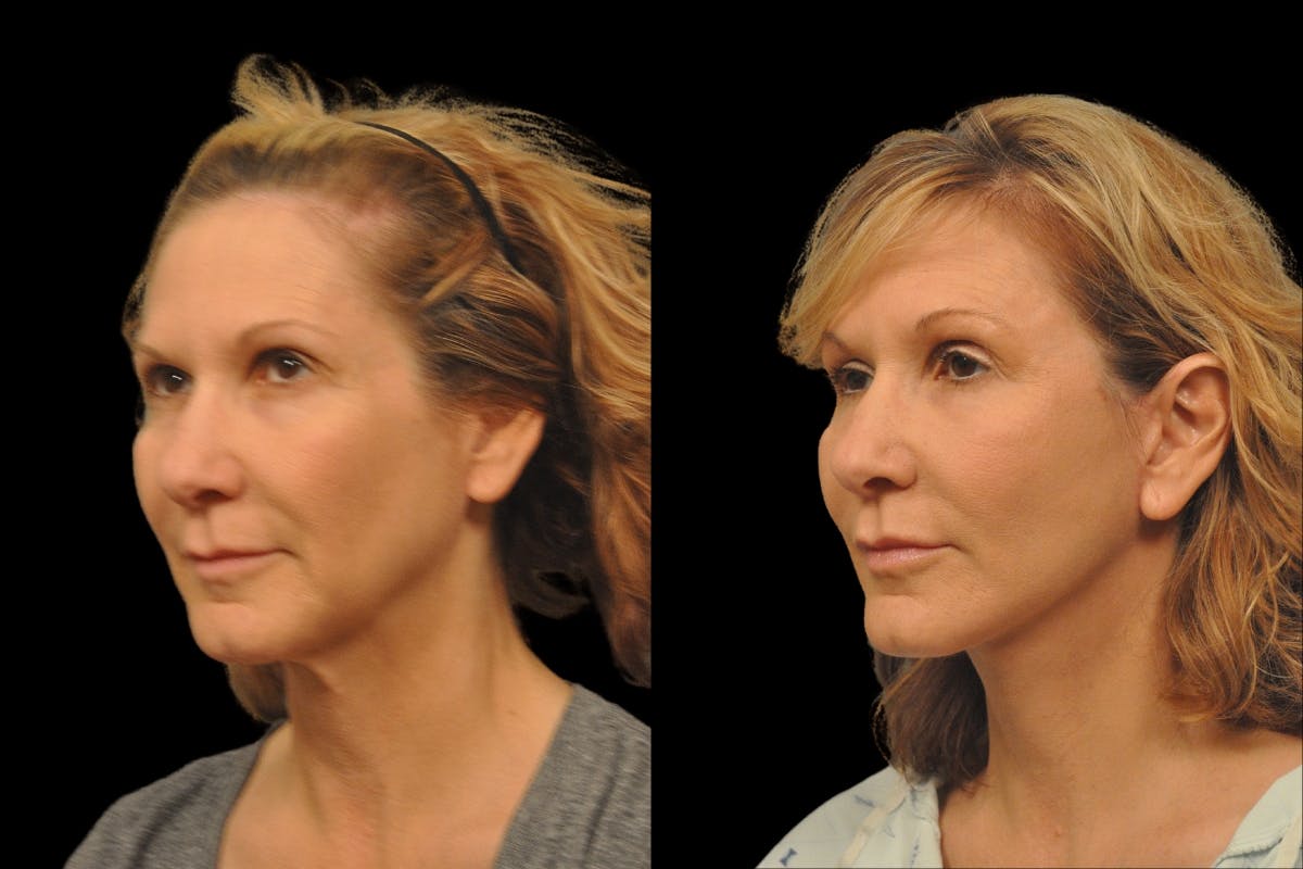 Changes Rapid Lift  Before & After Gallery - Patient 288670 - Image 1