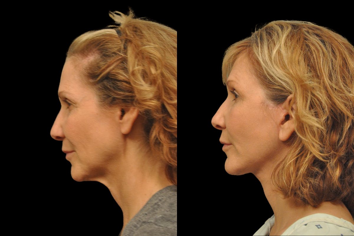 Changes Rapid Lift  Before & After Gallery - Patient 288670 - Image 2