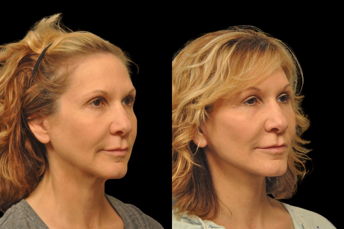 Changes Rapid Lift  Before & After Gallery - Patient 288670 - Image 3