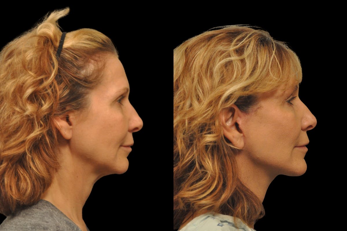 Changes Rapid Lift  Before & After Gallery - Patient 288670 - Image 4