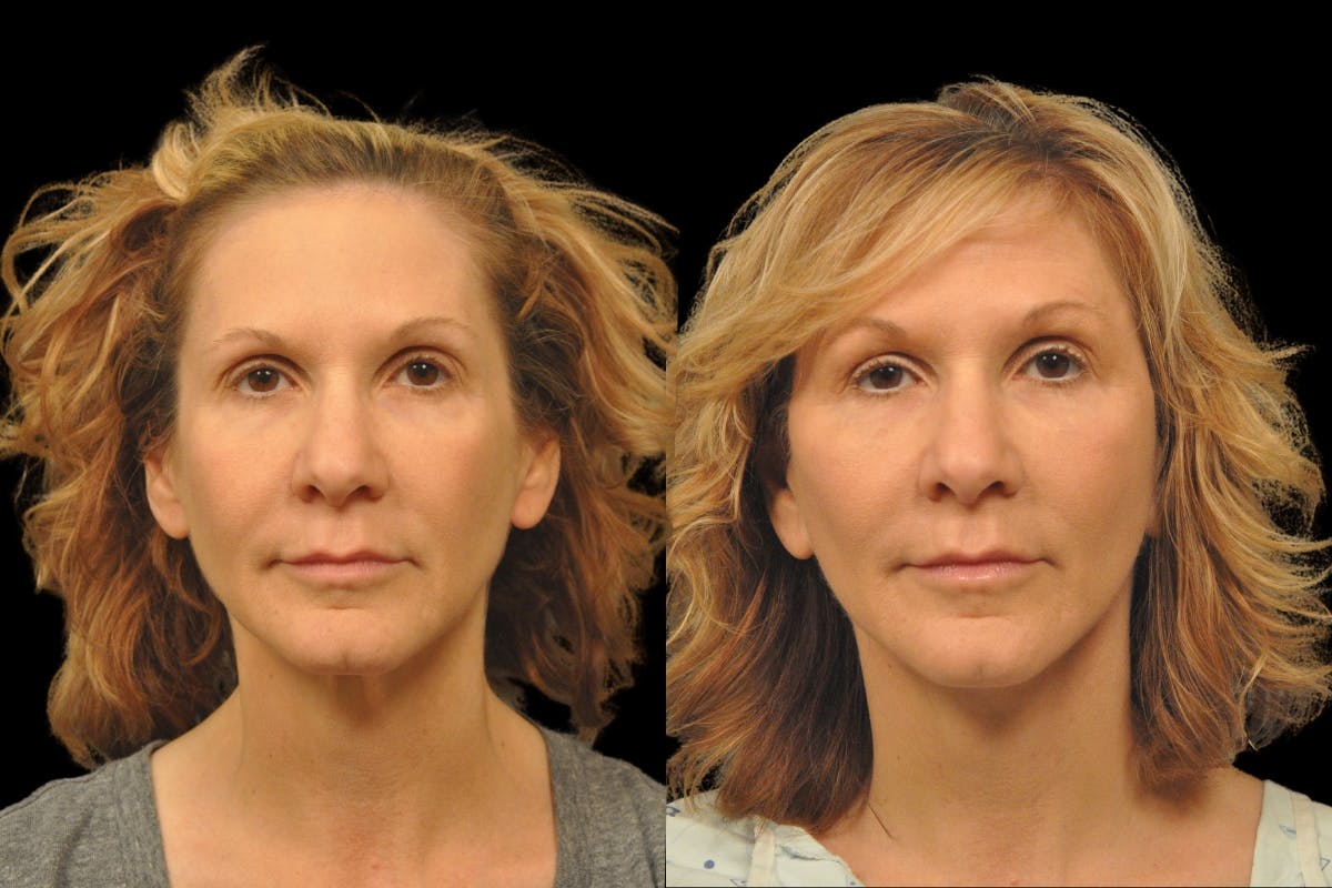 Changes Rapid Lift  Before & After Gallery - Patient 288670 - Image 5