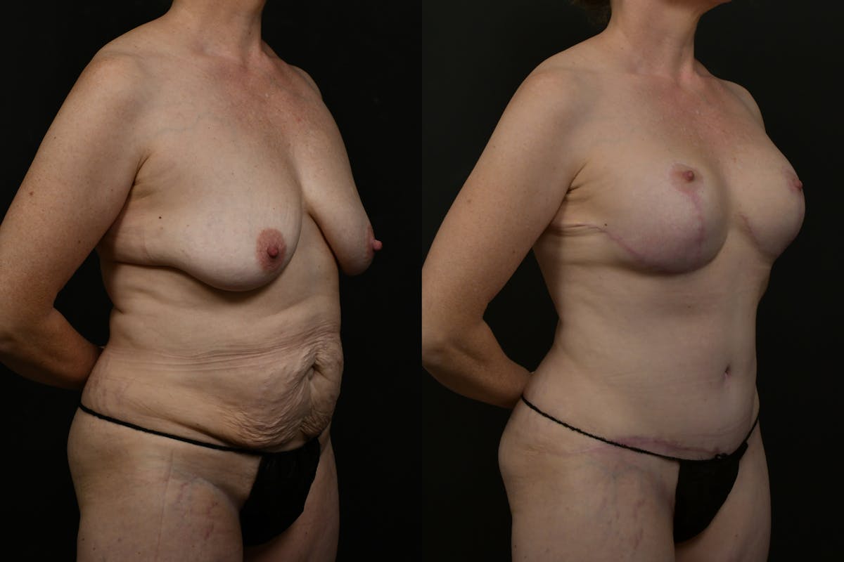 Mommy Makeover Before & After Gallery - Patient 316693 - Image 10