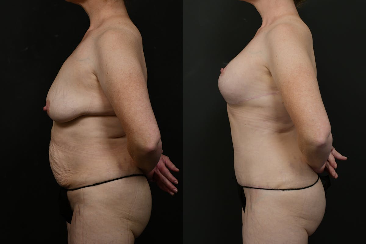 Mommy Makeover Before & After Gallery - Patient 316693 - Image 13