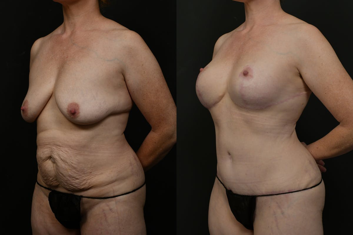 Mommy Makeover Before & After Gallery - Patient 316693 - Image 12
