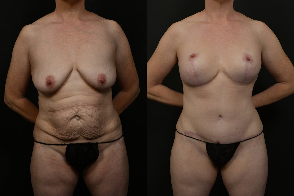 Mommy Makeover Before & After Gallery - Patient 316693 - Image 9