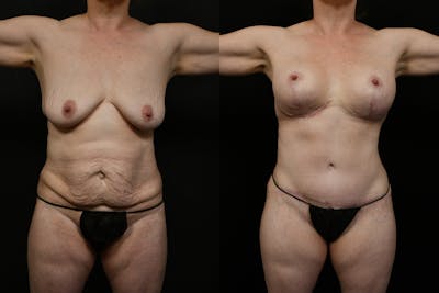 Tummy Tuck Before & After Gallery - Patient 323176 - Image 1