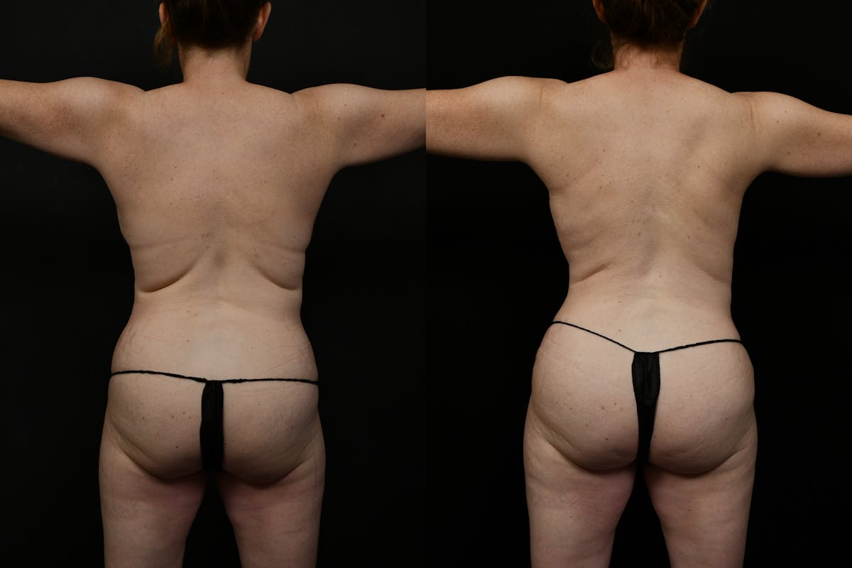 Tummy Tuck Before & After Gallery - Patient 323176 - Image 5