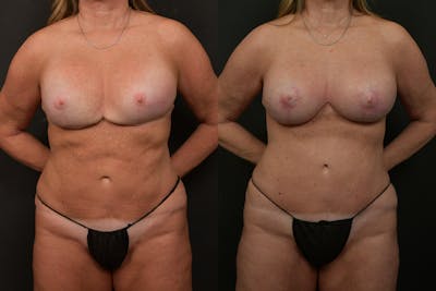 Breast Revision Before & After Gallery - Patient 341975 - Image 1