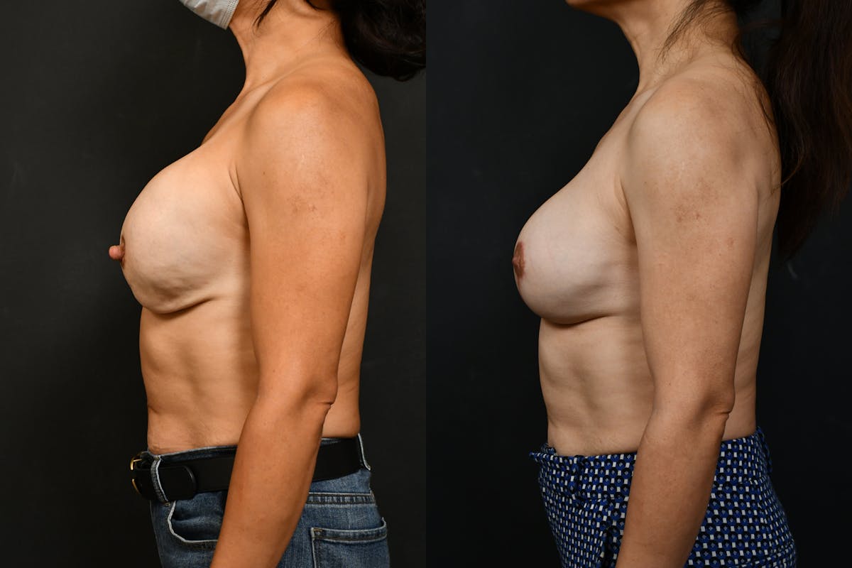 Breast Revision Before & After Gallery - Patient 275467 - Image 3