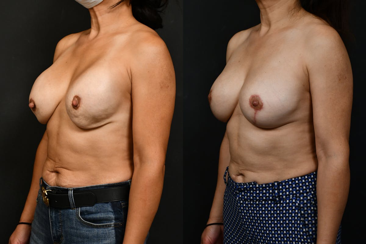Breast Revision Before & After Gallery - Patient 275467 - Image 2