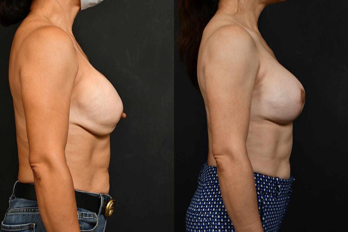 Breast Revision Before & After Gallery - Patient 275467 - Image 5
