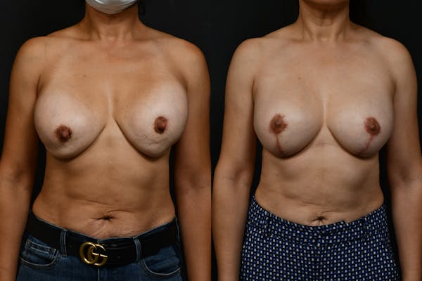 Breast Revision Before & After Gallery - Patient 275467 - Image 1