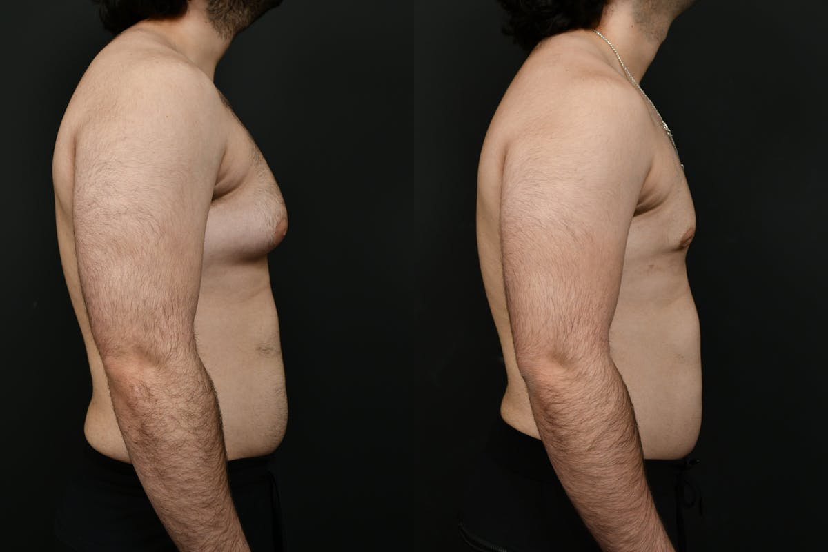 Gynecomastia Before & After Gallery - Patient 391542 - Image 2