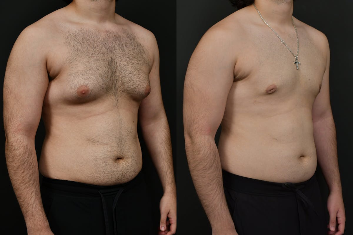 Gynecomastia Before & After Gallery - Patient 391542 - Image 3