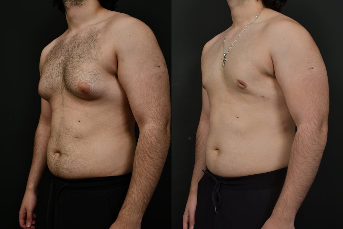 Gynecomastia Before & After Gallery - Patient 391542 - Image 5