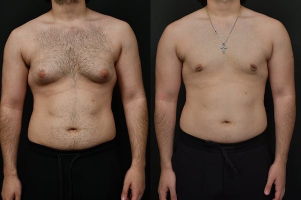 Gynecomastia Before & After Gallery - Patient 391542 - Image 1