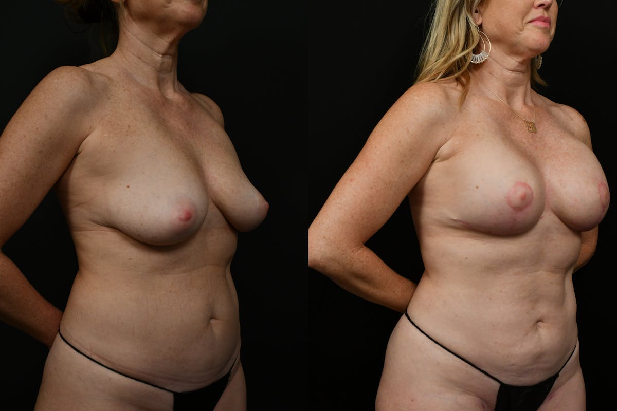 Breast Lift Before & After Gallery - Patient 259722 - Image 3