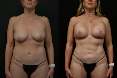 Reductive Augmentation Before & After Gallery - Patient 786391 - Image 1