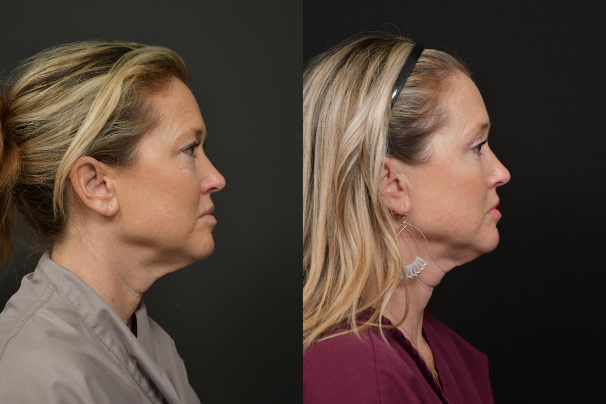 Eyelid Surgery Before & After Gallery - Patient 244667 - Image 5