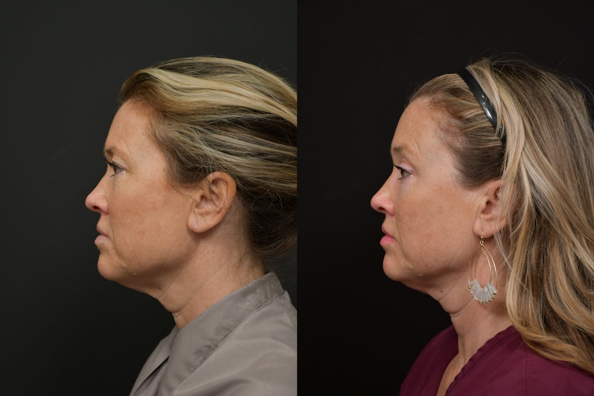 Eyelid Surgery Before & After Gallery - Patient 244667 - Image 3