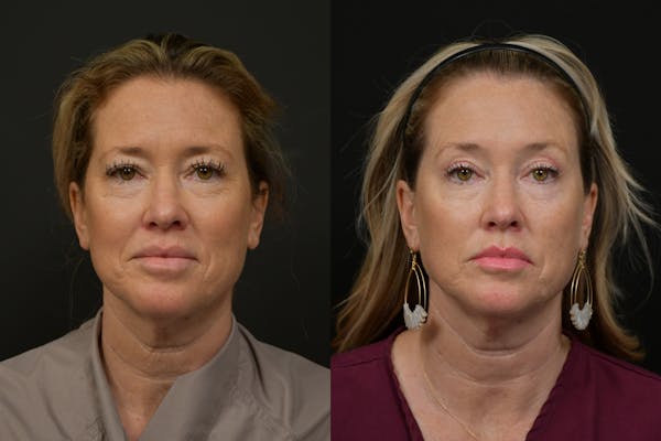 Brow Lift Before & After Gallery - Patient 221733 - Image 1