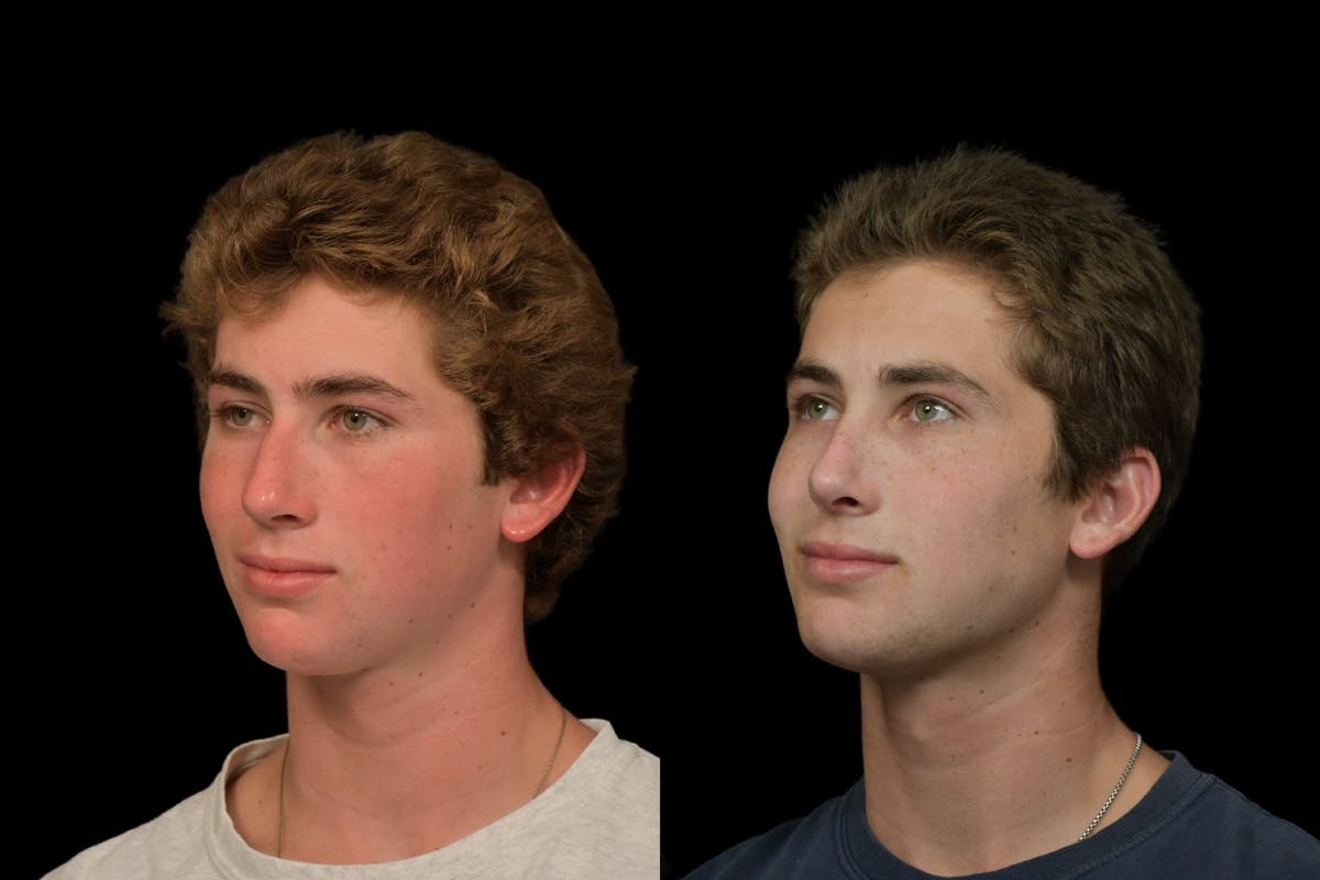 Rhinoplasty For Men Before & After Gallery - Patient 318603 - Image 2