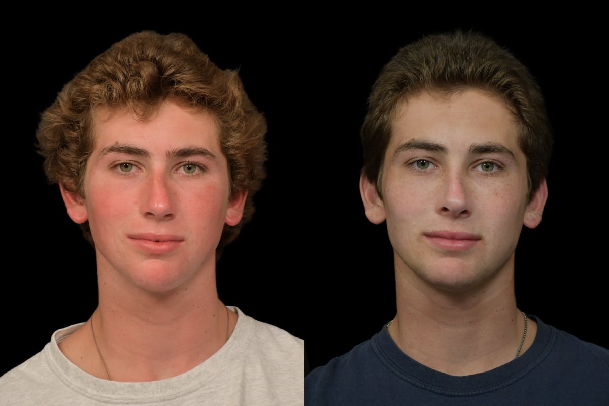 Rhinoplasty For Men Before & After Gallery - Patient 318603 - Image 3