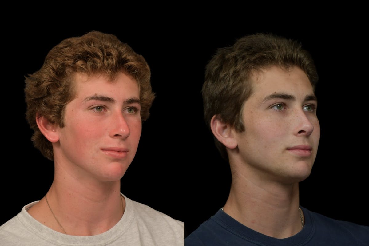 Rhinoplasty For Men Before & After Gallery - Patient 318603 - Image 4