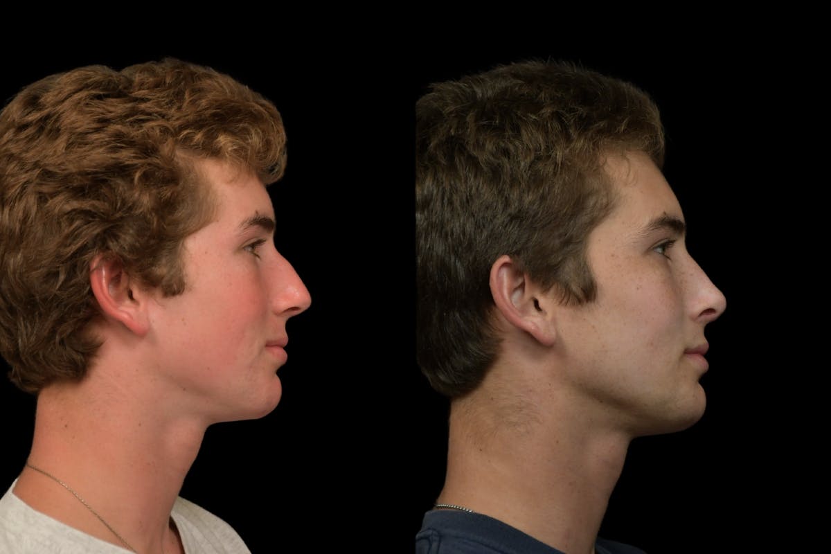 Rhinoplasty For Men Before & After Gallery - Patient 318603 - Image 5