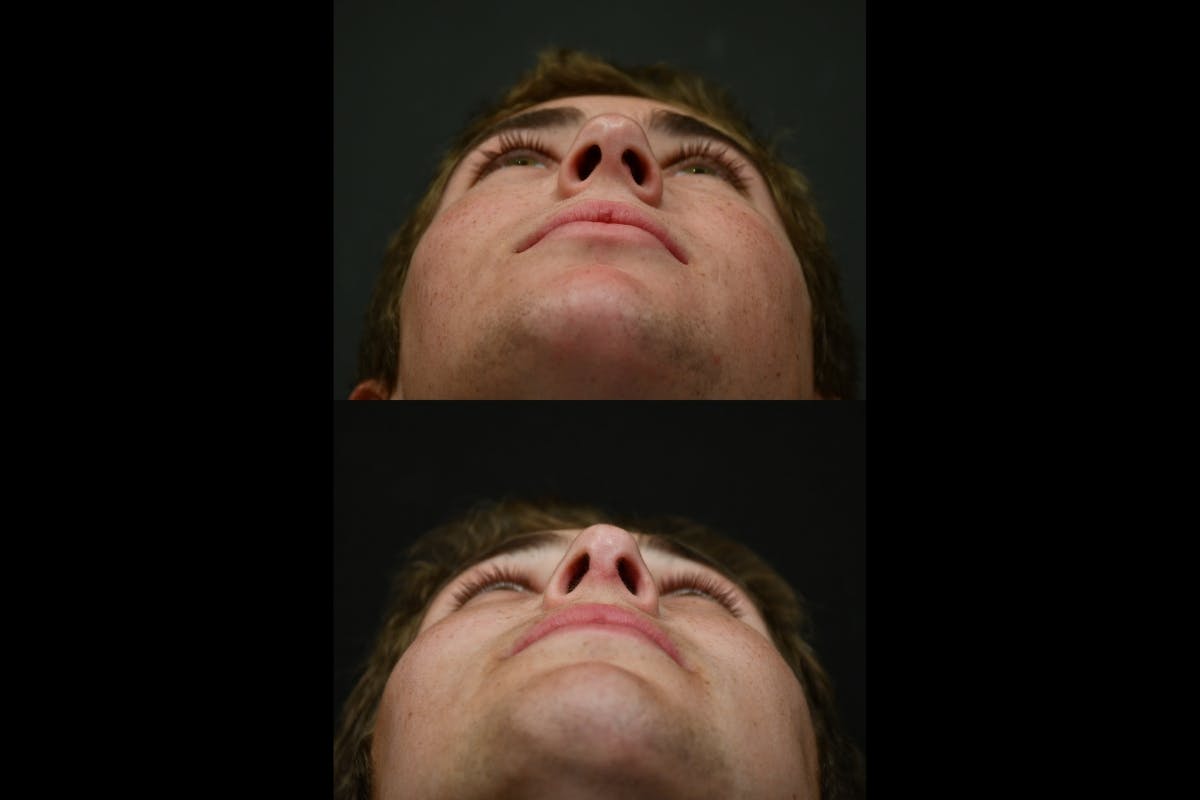 Rhinoplasty For Men Before & After Gallery - Patient 318603 - Image 6