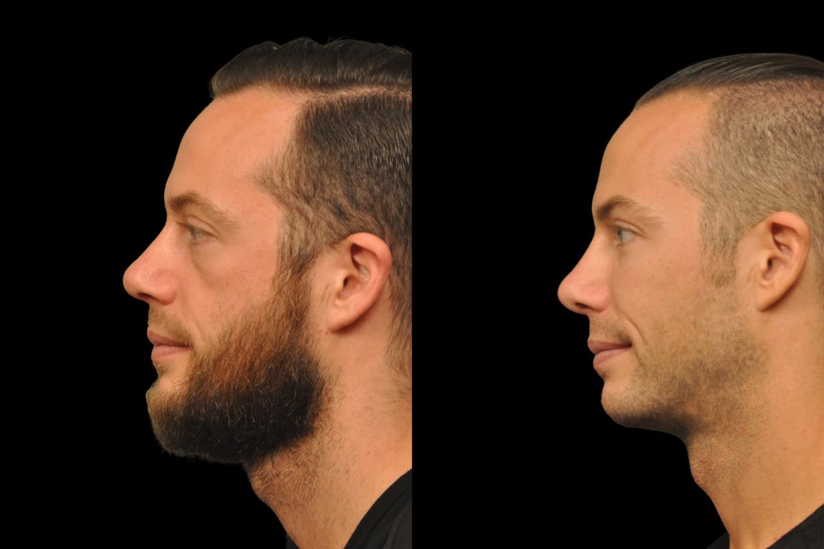 Rhinoplasty For Men Before & After Gallery - Patient 143993 - Image 1