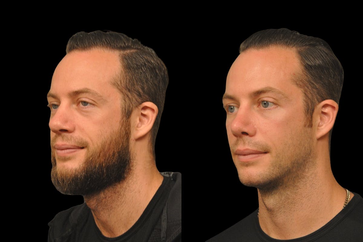 Rhinoplasty For Men Before & After Gallery - Patient 143993 - Image 2