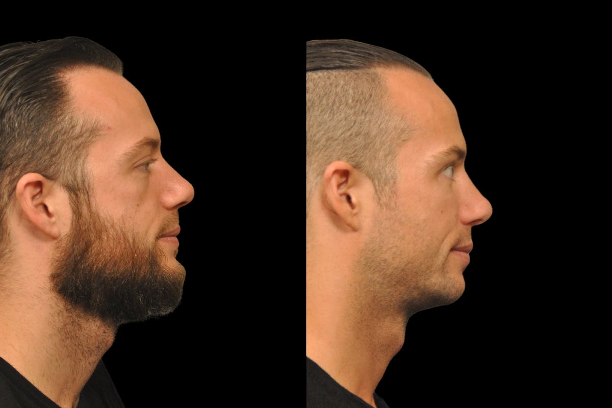 Rhinoplasty For Men Before & After Gallery - Patient 143993 - Image 3