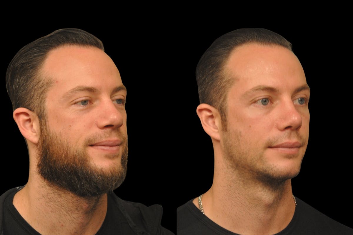 Rhinoplasty For Men Before & After Gallery - Patient 143993 - Image 4