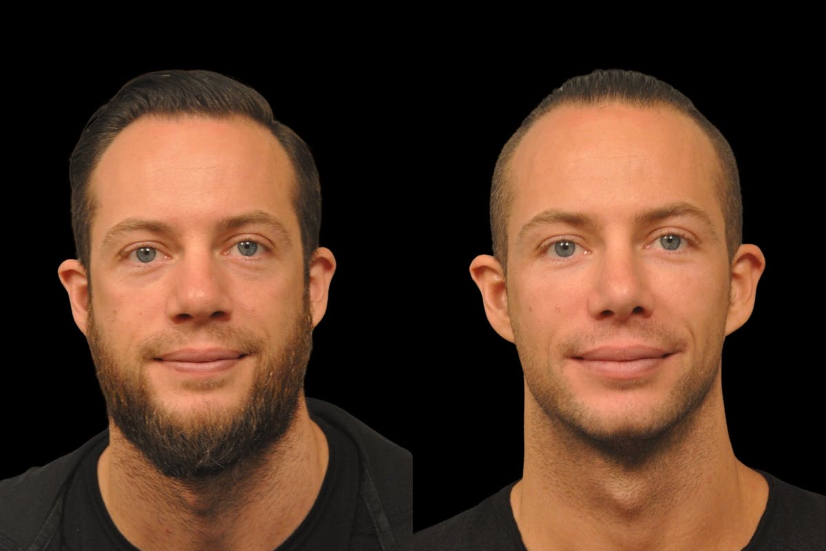 Rhinoplasty For Men Before & After Gallery - Patient 143993 - Image 5