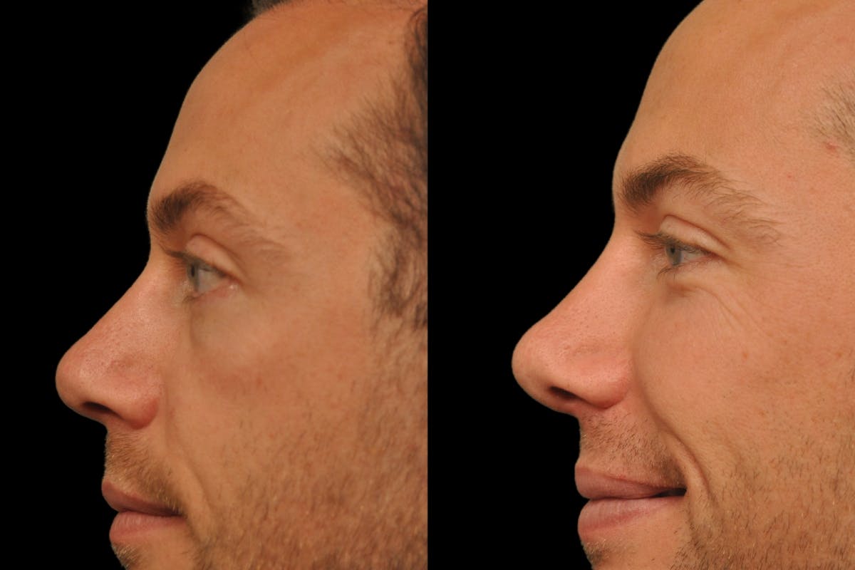 Rhinoplasty For Men Before & After Gallery - Patient 143993 - Image 6