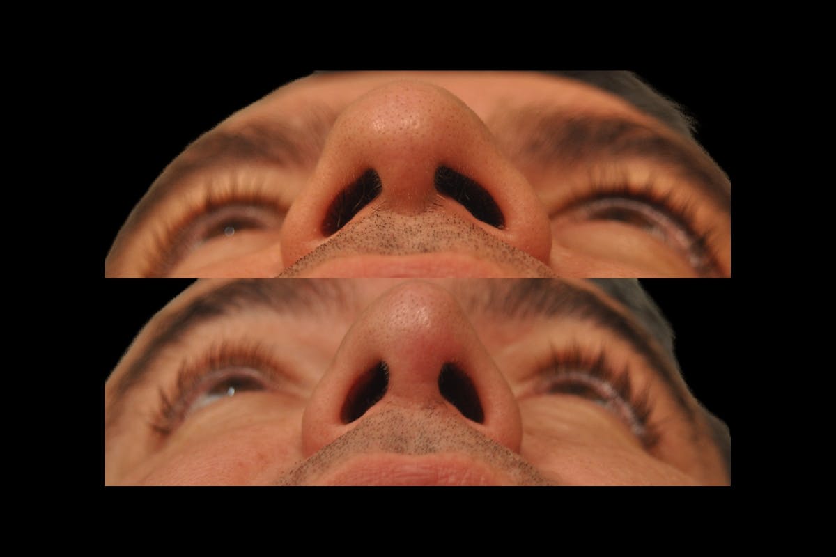 Rhinoplasty For Men Before & After Gallery - Patient 325074 - Image 8